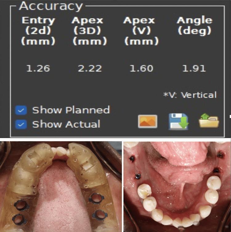 https://cdn.ncbi.nlm.nih.gov/pmc/blobs/0072/11061662/9fb824e67acb/cureus-0016-00000057331-i05.jpg
