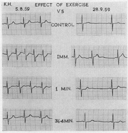 https://cdn.ncbi.nlm.nih.gov/pmc/blobs/007d/1017798/c069824d4704/brheartj00365-0003-a.jpg