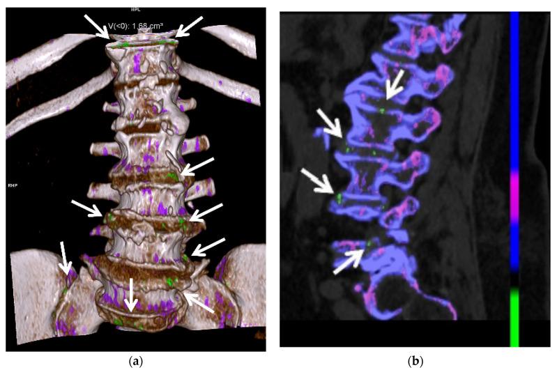 https://cdn.ncbi.nlm.nih.gov/pmc/blobs/009b/8745871/7210da2fcbc6/jcm-11-00166-g014.jpg
