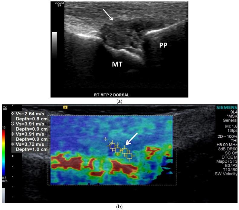 https://cdn.ncbi.nlm.nih.gov/pmc/blobs/009b/8745871/a11a41f2641d/jcm-11-00166-g011.jpg