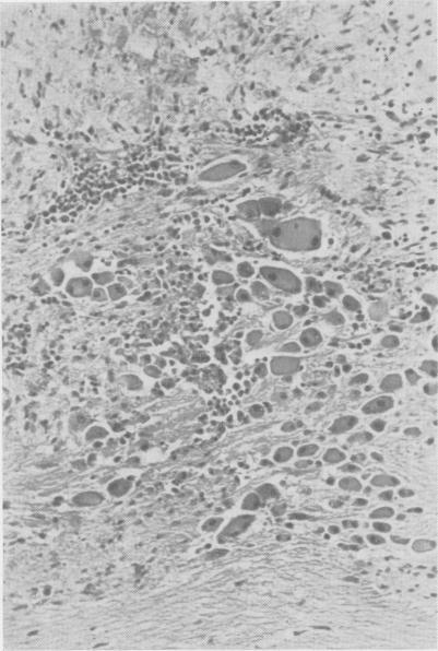 https://cdn.ncbi.nlm.nih.gov/pmc/blobs/0109/1613514/36266bb6eb62/annsurg01304-0040-b.jpg