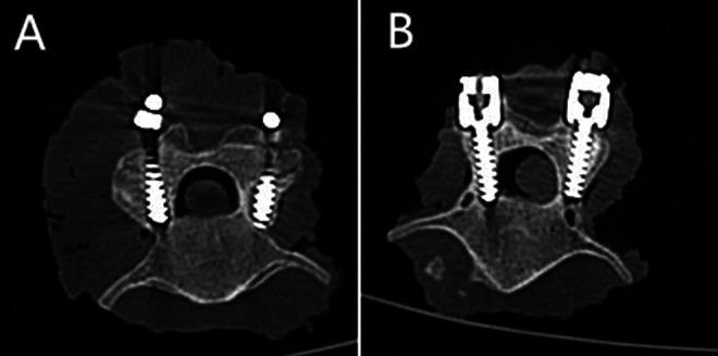 https://cdn.ncbi.nlm.nih.gov/pmc/blobs/0117/9972285/e7fe9295f92c/10.1177_2192568221996692-fig2.jpg