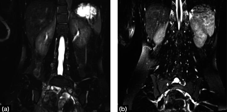 https://cdn.ncbi.nlm.nih.gov/pmc/blobs/0124/11672224/d2ceff9b559a/cureus-0016-00000074564-i03.jpg
