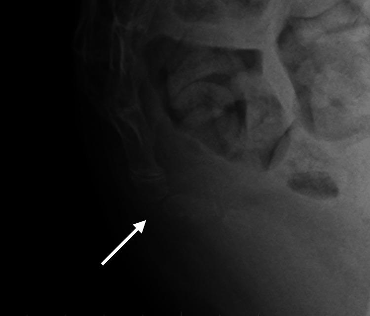https://cdn.ncbi.nlm.nih.gov/pmc/blobs/0124/11672224/e58e5551b438/cureus-0016-00000074564-i01.jpg