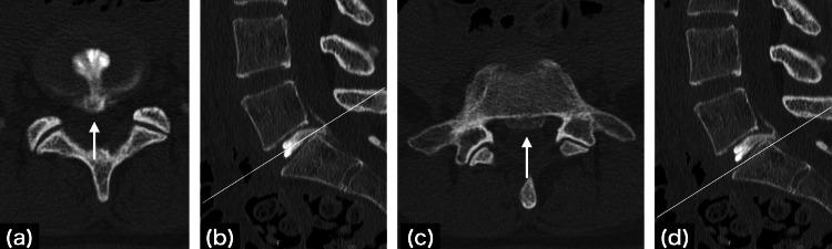 https://cdn.ncbi.nlm.nih.gov/pmc/blobs/0124/11672224/e8c0f989e4df/cureus-0016-00000074564-i04.jpg