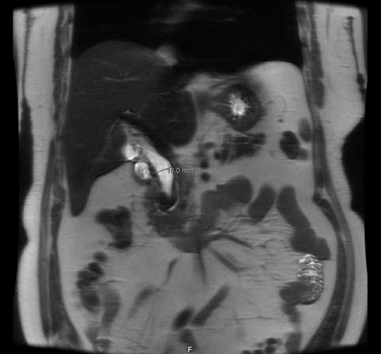 https://cdn.ncbi.nlm.nih.gov/pmc/blobs/0157/8723720/67bf39053eca/cureus-0013-00000020093-i03.jpg