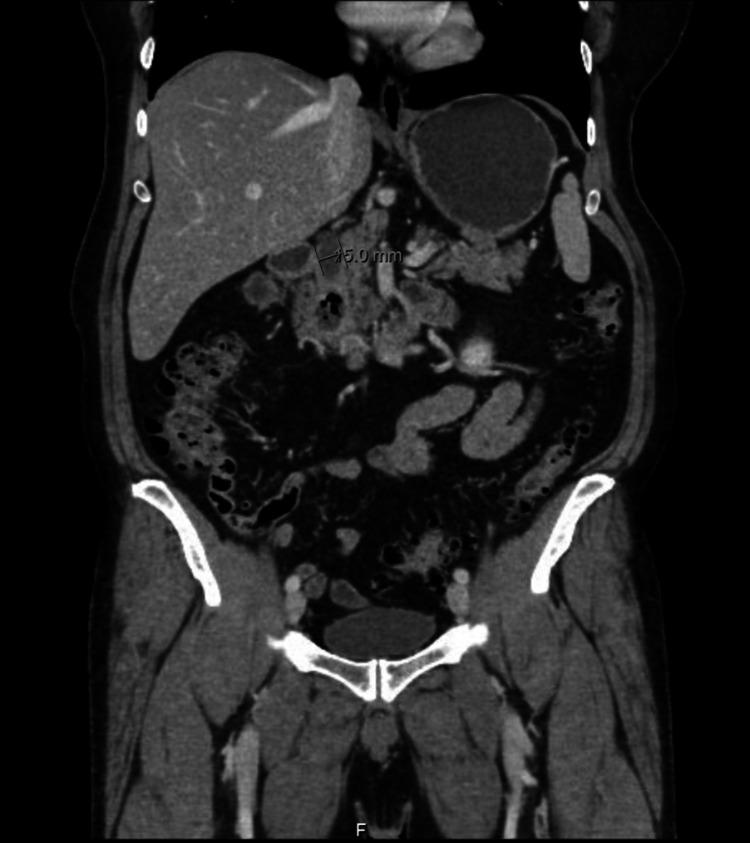 https://cdn.ncbi.nlm.nih.gov/pmc/blobs/0157/8723720/f69d1257896e/cureus-0013-00000020093-i01.jpg