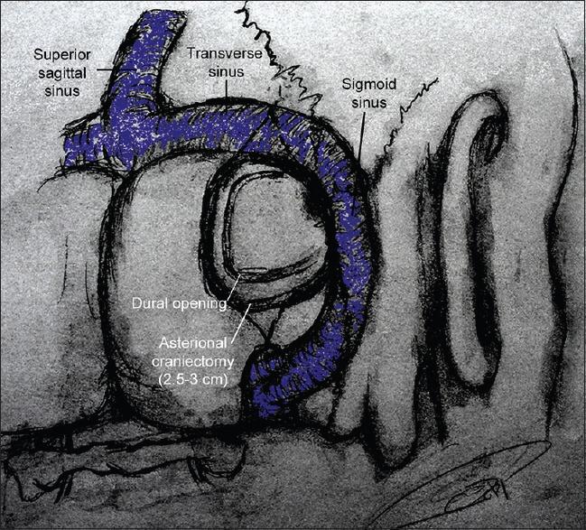 https://cdn.ncbi.nlm.nih.gov/pmc/blobs/0197/4866068/1424992af314/SNI-7-51-g001.jpg