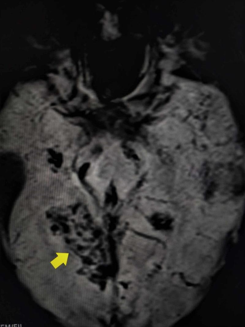 https://cdn.ncbi.nlm.nih.gov/pmc/blobs/01ad/7550030/0053e96f66f3/cureus-0012-00000010403-i03.jpg