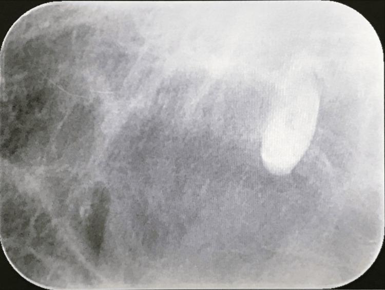 https://cdn.ncbi.nlm.nih.gov/pmc/blobs/01bb/11338629/58bf375d91e3/cureus-0016-00000065130-i02.jpg