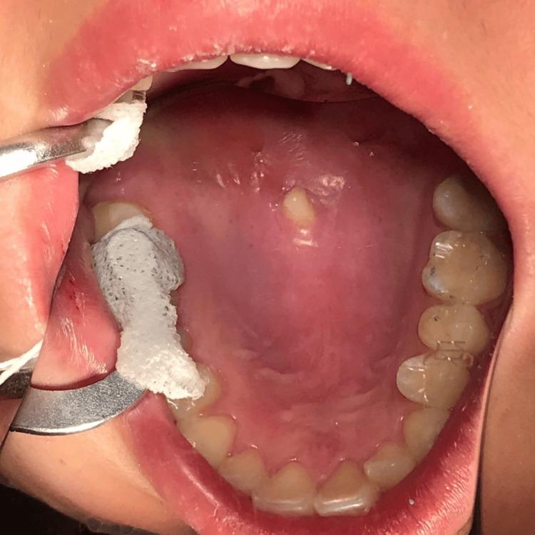 https://cdn.ncbi.nlm.nih.gov/pmc/blobs/01bb/11338629/c3fdf2914d5d/cureus-0016-00000065130-i01.jpg