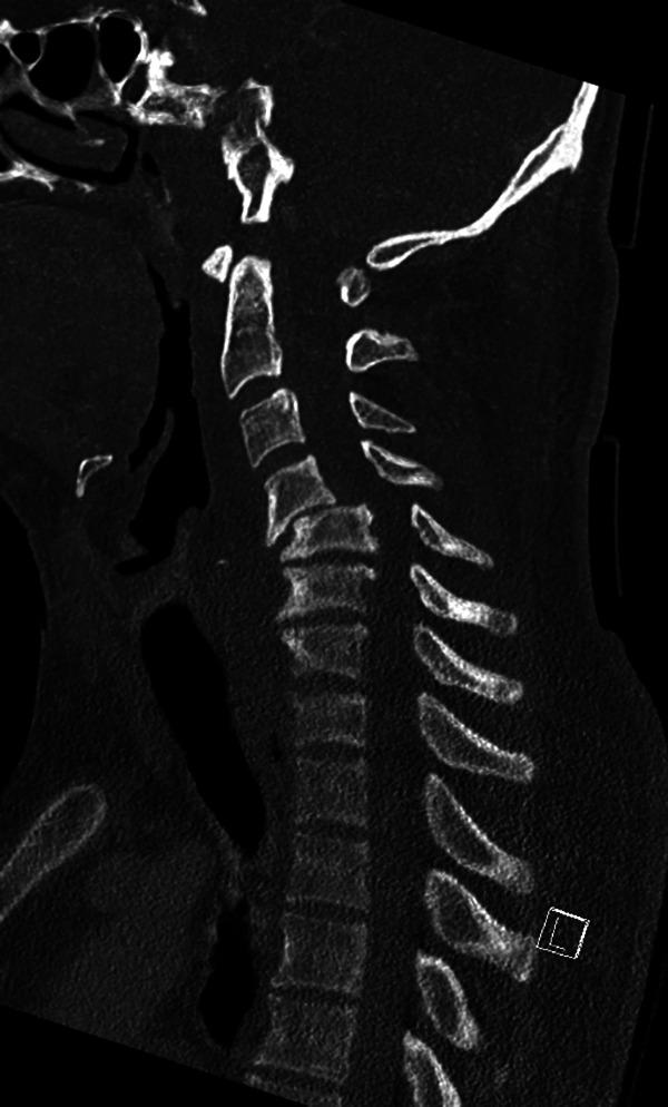 https://cdn.ncbi.nlm.nih.gov/pmc/blobs/0202/8453686/6e21cfeeb2a8/10.1177_2192568220944124-fig4.jpg