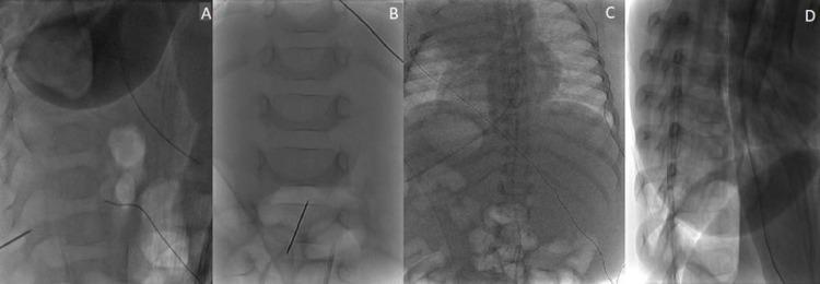 https://cdn.ncbi.nlm.nih.gov/pmc/blobs/0263/9165922/973062b85876/cureus-0014-00000024735-i02.jpg