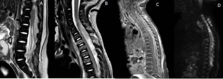 https://cdn.ncbi.nlm.nih.gov/pmc/blobs/0263/9165922/dae7ca62c25f/cureus-0014-00000024735-i01.jpg