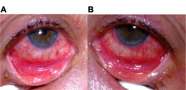 https://cdn.ncbi.nlm.nih.gov/pmc/blobs/0288/3674754/f35e0a79d144/opth-7-1031Fig2.jpg