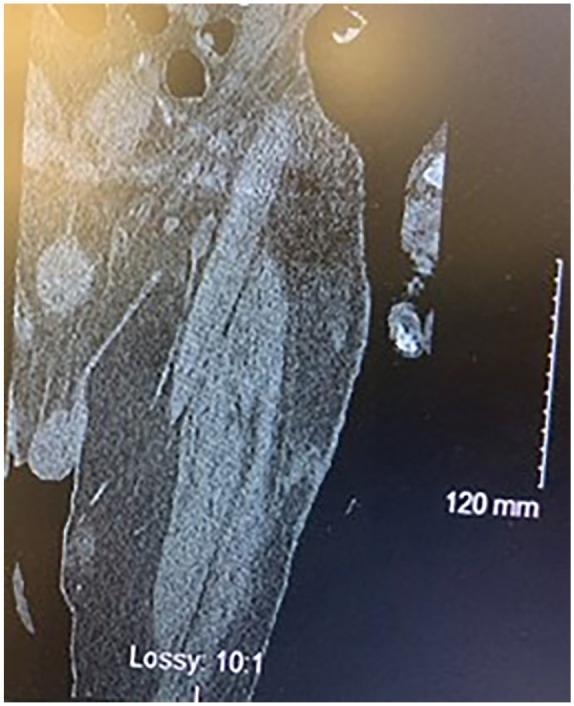 https://cdn.ncbi.nlm.nih.gov/pmc/blobs/0290/8283217/6c0def910d35/10.1177_23247096211028078-fig3.jpg
