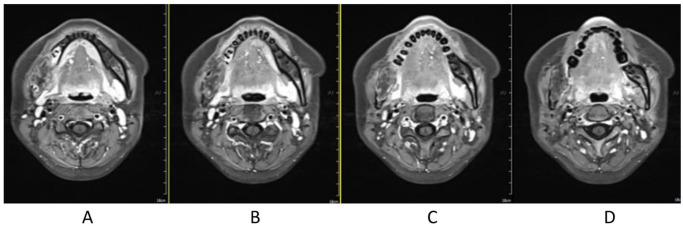 https://cdn.ncbi.nlm.nih.gov/pmc/blobs/02cb/8958705/7f81c8712695/10.1177_2050313X221082416-fig9.jpg