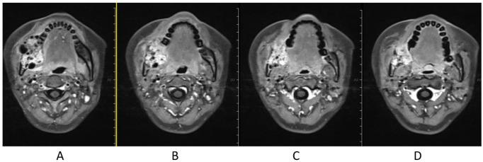 https://cdn.ncbi.nlm.nih.gov/pmc/blobs/02cb/8958705/8f2fd7110eb1/10.1177_2050313X221082416-fig5.jpg