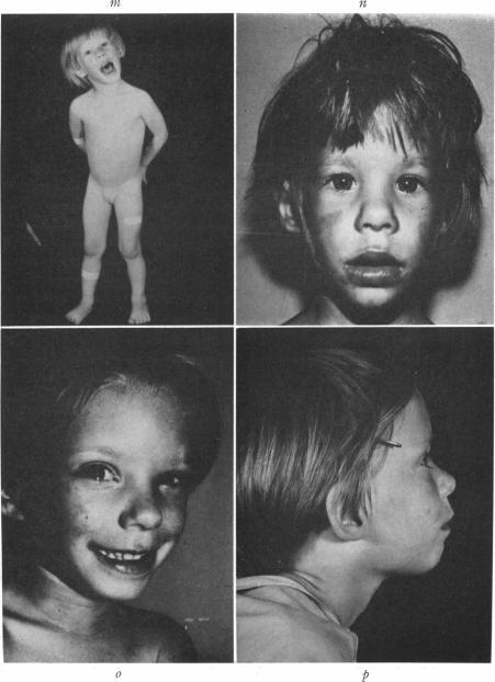 https://cdn.ncbi.nlm.nih.gov/pmc/blobs/02ce/1706430/a0c111a87e20/ajhg00380-0101-a.jpg