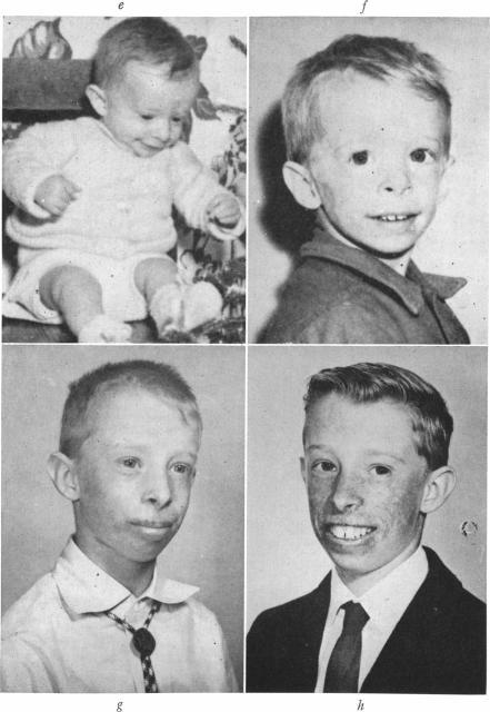 https://cdn.ncbi.nlm.nih.gov/pmc/blobs/02ce/1706430/ef033dad490a/ajhg00380-0099-a.jpg