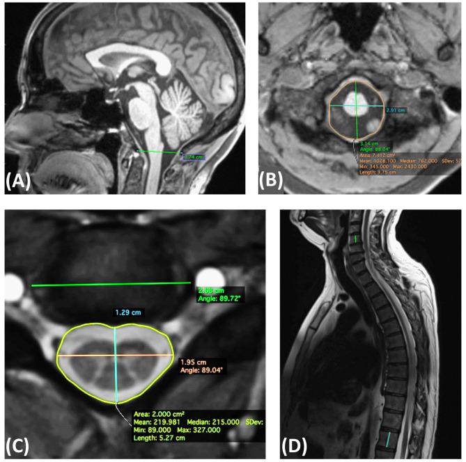 https://cdn.ncbi.nlm.nih.gov/pmc/blobs/02e0/8027254/18b525e124f0/fneur-12-637198-g0002.jpg