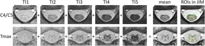 https://cdn.ncbi.nlm.nih.gov/pmc/blobs/02e0/8027254/502b9d05ffd6/fneur-12-637198-g0001.jpg