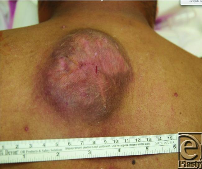 https://cdn.ncbi.nlm.nih.gov/pmc/blobs/03ef/3754362/b01e7349fe12/eplasty13e44_fig1.jpg