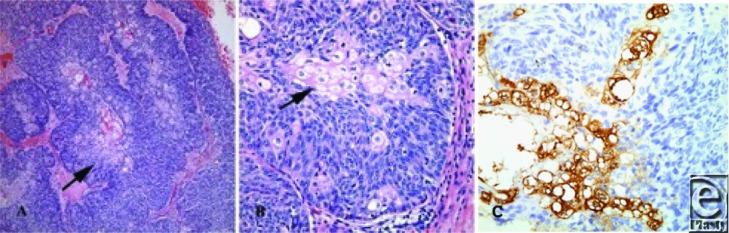 https://cdn.ncbi.nlm.nih.gov/pmc/blobs/03ef/3754362/b1d56d22f25c/eplasty13e44_fig3.jpg