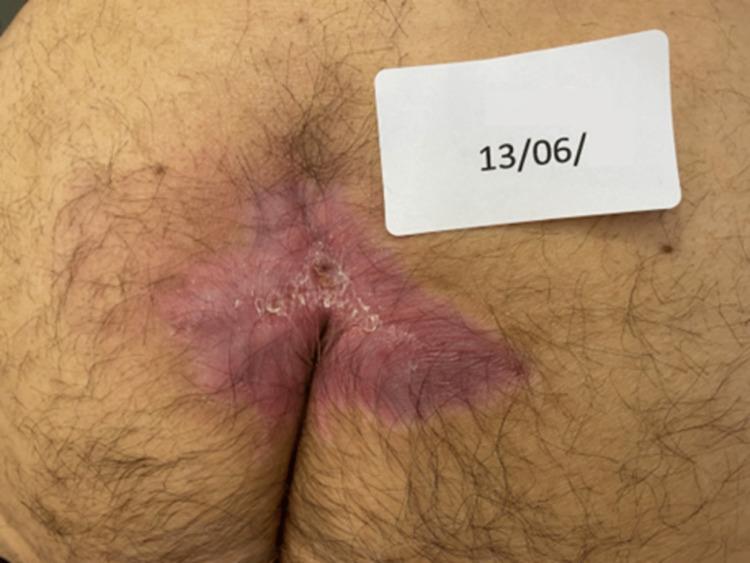 https://cdn.ncbi.nlm.nih.gov/pmc/blobs/0416/9303832/3c0cc0d99ed7/cureus-0014-00000027060-i03.jpg