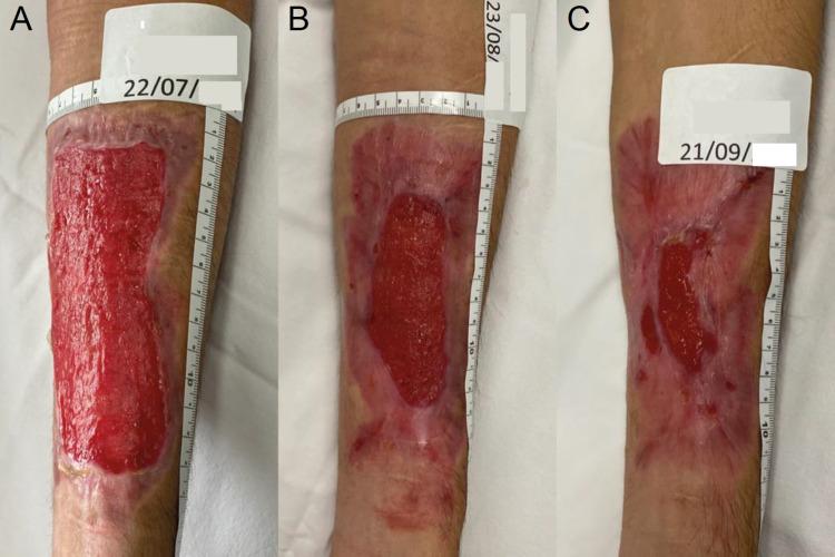 https://cdn.ncbi.nlm.nih.gov/pmc/blobs/0416/9303832/86c030e79e70/cureus-0014-00000027060-i07.jpg