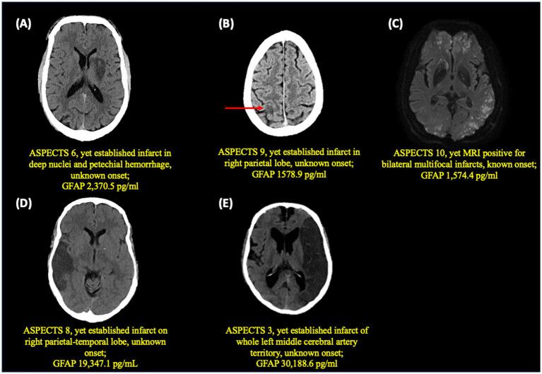 https://cdn.ncbi.nlm.nih.gov/pmc/blobs/0418/11704488/9153a93d514a/fneur-15-1470718-g003.jpg