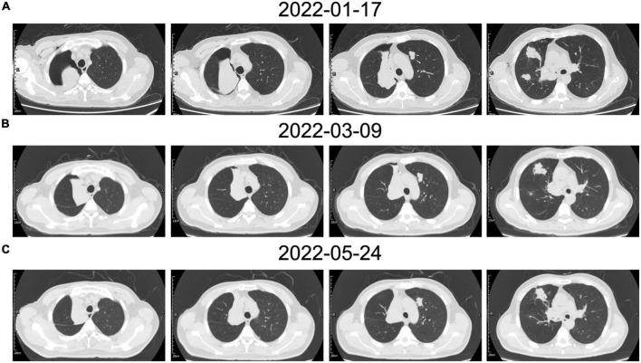 https://cdn.ncbi.nlm.nih.gov/pmc/blobs/0429/9799331/2c08df3b133b/fmed-09-1066870-g004.jpg