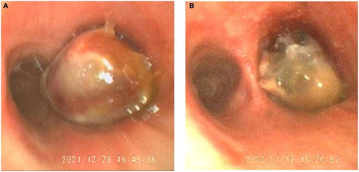 https://cdn.ncbi.nlm.nih.gov/pmc/blobs/0429/9799331/9bde04b1c4e3/fmed-09-1066870-g002.jpg