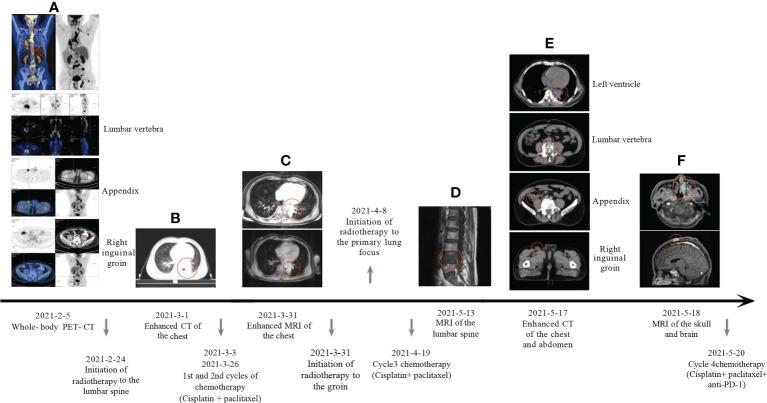 https://cdn.ncbi.nlm.nih.gov/pmc/blobs/043f/10160372/6f743a782cde/fonc-13-1138871-g002.jpg