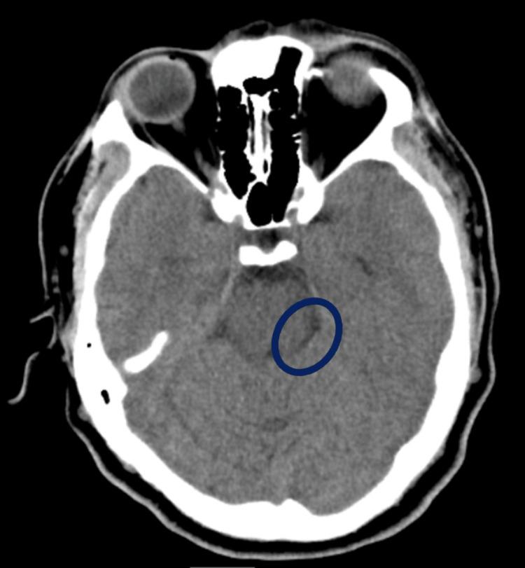 https://cdn.ncbi.nlm.nih.gov/pmc/blobs/0440/10439507/cd2ed7603c6d/cureus-0015-00000042176-i03.jpg