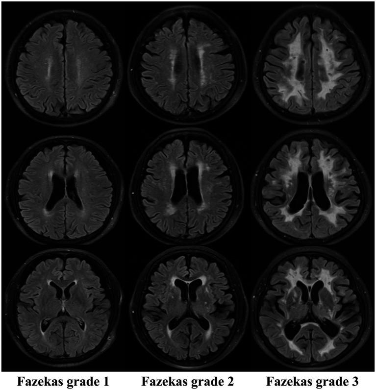 https://cdn.ncbi.nlm.nih.gov/pmc/blobs/0442/12417195/4a6bd7e170e4/fneur-16-1647724-g002.jpg