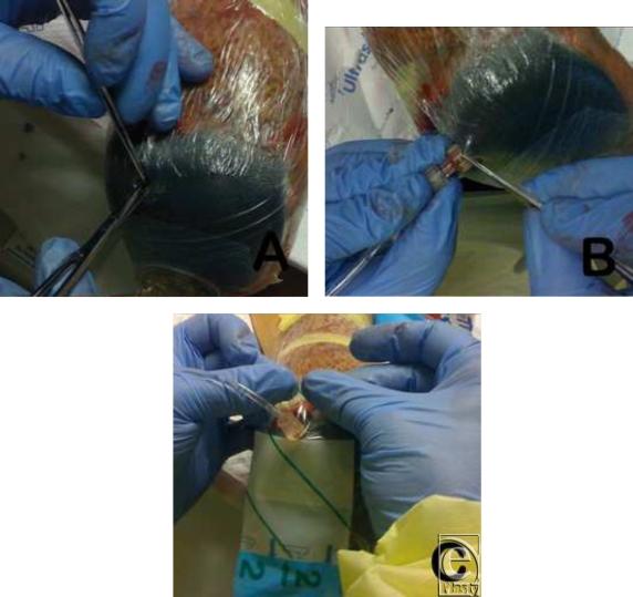 https://cdn.ncbi.nlm.nih.gov/pmc/blobs/045a/2806786/bc5d174f3aa7/eplasty10e09_fig4.jpg