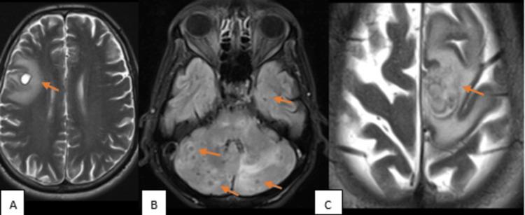 https://cdn.ncbi.nlm.nih.gov/pmc/blobs/04ca/10263174/92b319bb4990/cureus-0015-00000039003-i01.jpg