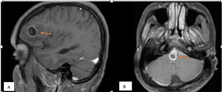 https://cdn.ncbi.nlm.nih.gov/pmc/blobs/04ca/10263174/d9fbeb973337/cureus-0015-00000039003-i04.jpg