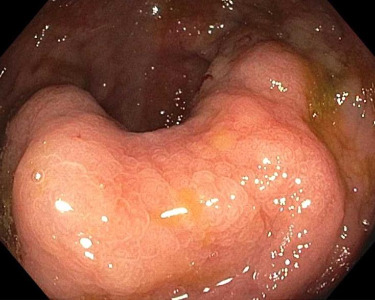 https://cdn.ncbi.nlm.nih.gov/pmc/blobs/04d3/12336565/3b89ef773d4b/egastro-3-3-g003.jpg