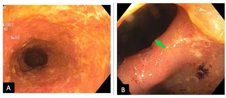 https://cdn.ncbi.nlm.nih.gov/pmc/blobs/04d3/12336565/79abad4cdcbc/egastro-3-3-g002.jpg