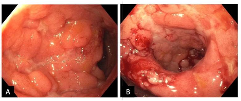 https://cdn.ncbi.nlm.nih.gov/pmc/blobs/04d3/12336565/f6698c7d4b41/egastro-3-3-g004.jpg