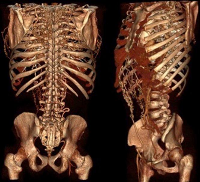 https://cdn.ncbi.nlm.nih.gov/pmc/blobs/04ff/5851190/c9ffd4441724/radcr359-fig-0005.jpg
