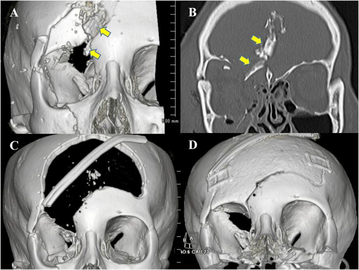https://cdn.ncbi.nlm.nih.gov/pmc/blobs/057c/5862542/4ac7814fdc07/gr1.jpg