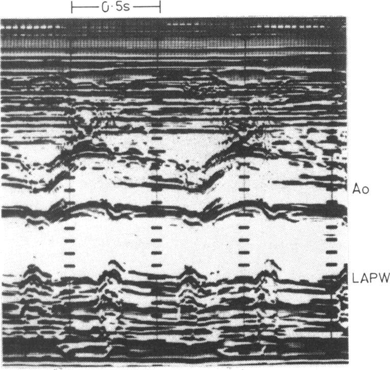 https://cdn.ncbi.nlm.nih.gov/pmc/blobs/05da/481403/a5325113f7e8/brheartj00141-0046-b.jpg
