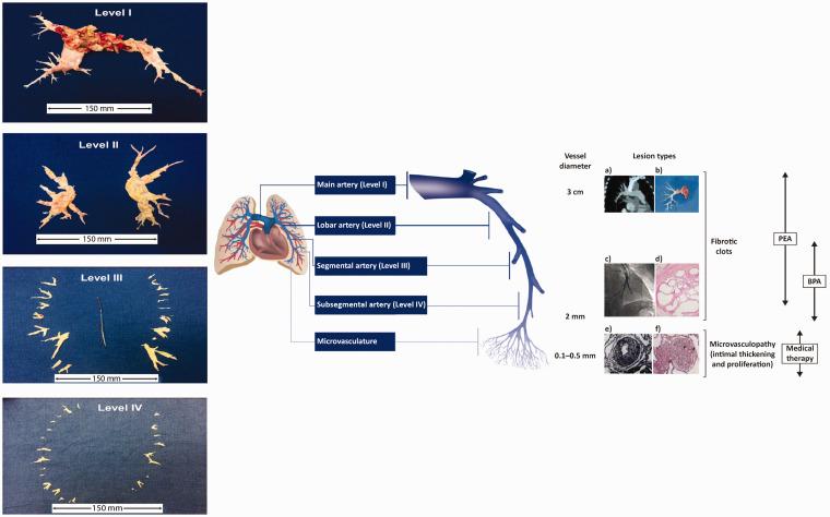 https://cdn.ncbi.nlm.nih.gov/pmc/blobs/060b/8150486/93f0025ea8dd/10.1177_20458940211007372-fig2.jpg