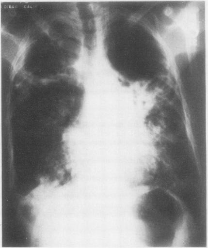 https://cdn.ncbi.nlm.nih.gov/pmc/blobs/0631/459369/2a3068a26c1d/thorax00199-0070-a.jpg