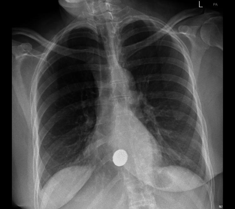 https://cdn.ncbi.nlm.nih.gov/pmc/blobs/0652/12315050/4c686e94d353/cureus-0017-00000087157-i01.jpg