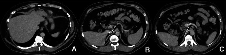 https://cdn.ncbi.nlm.nih.gov/pmc/blobs/0664/11242740/b0cfd58c6a6c/cureus-0016-00000062234-i01.jpg