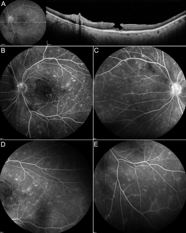 https://cdn.ncbi.nlm.nih.gov/pmc/blobs/067e/7846948/abca73183c0e/iovs-62-1-34-f005.jpg